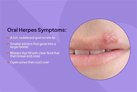 Herpes Symptoms in Men: Signs and Symptoms of。